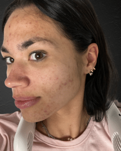 EMatrix + Chemical Peels + Skincare